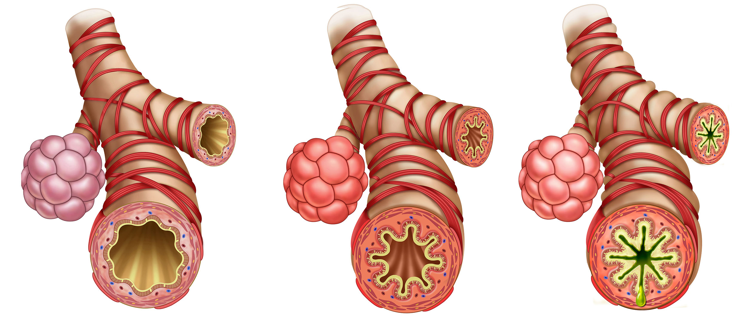 3a4 Respiratory Disorders