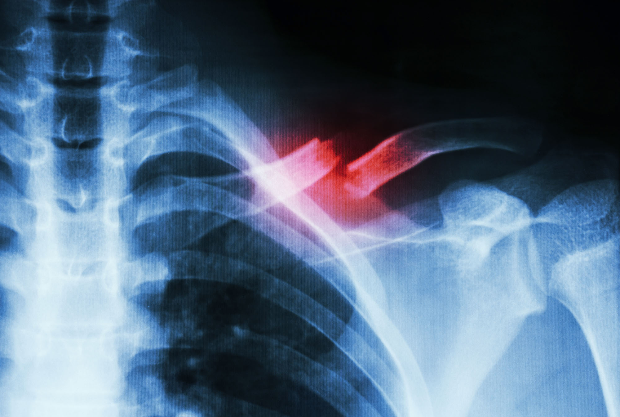 The red highlighted area shows a break that occurred when the patient tried to break their fall with their arm, a common reflex.