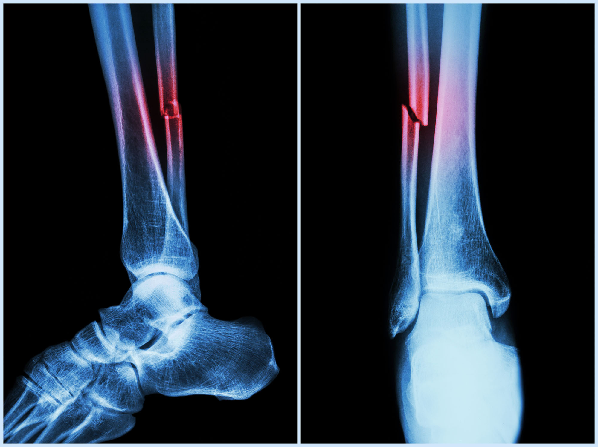 Two different views of a break in the smaller of the two lower leg bones.