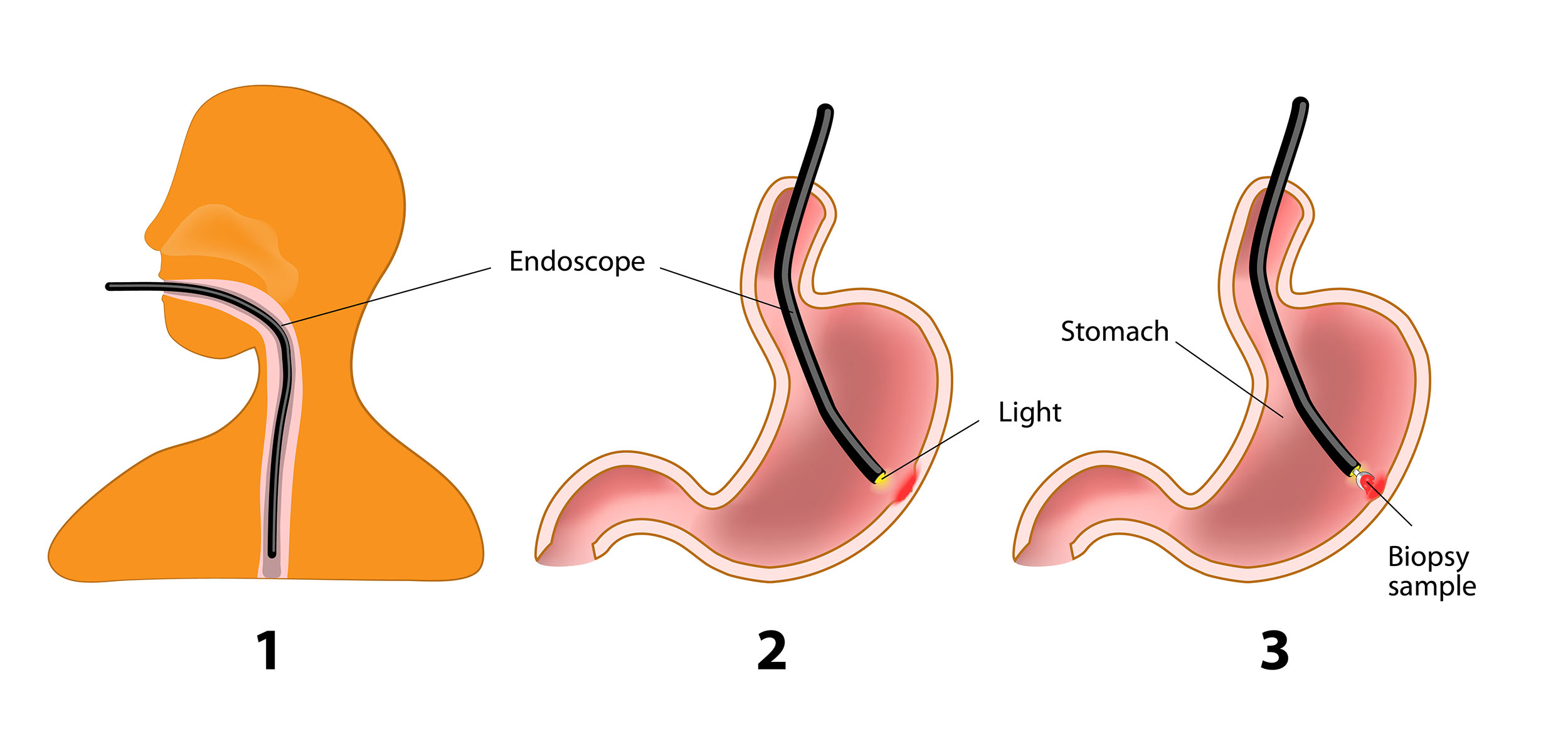 3a2 Digestive Disorders