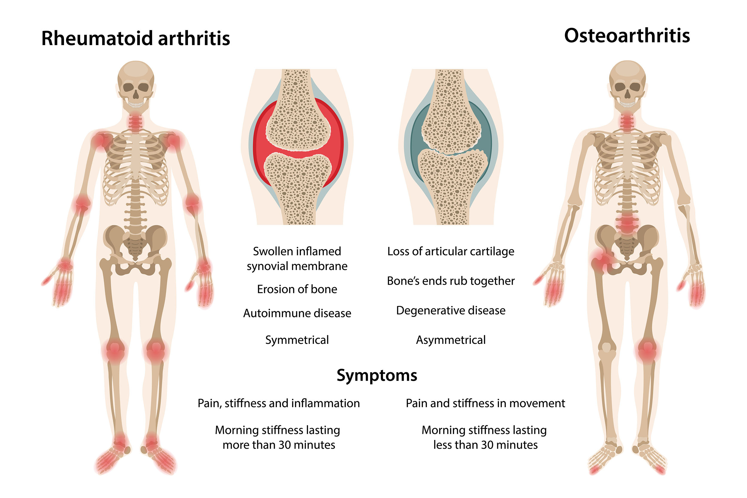 arthritis compar
