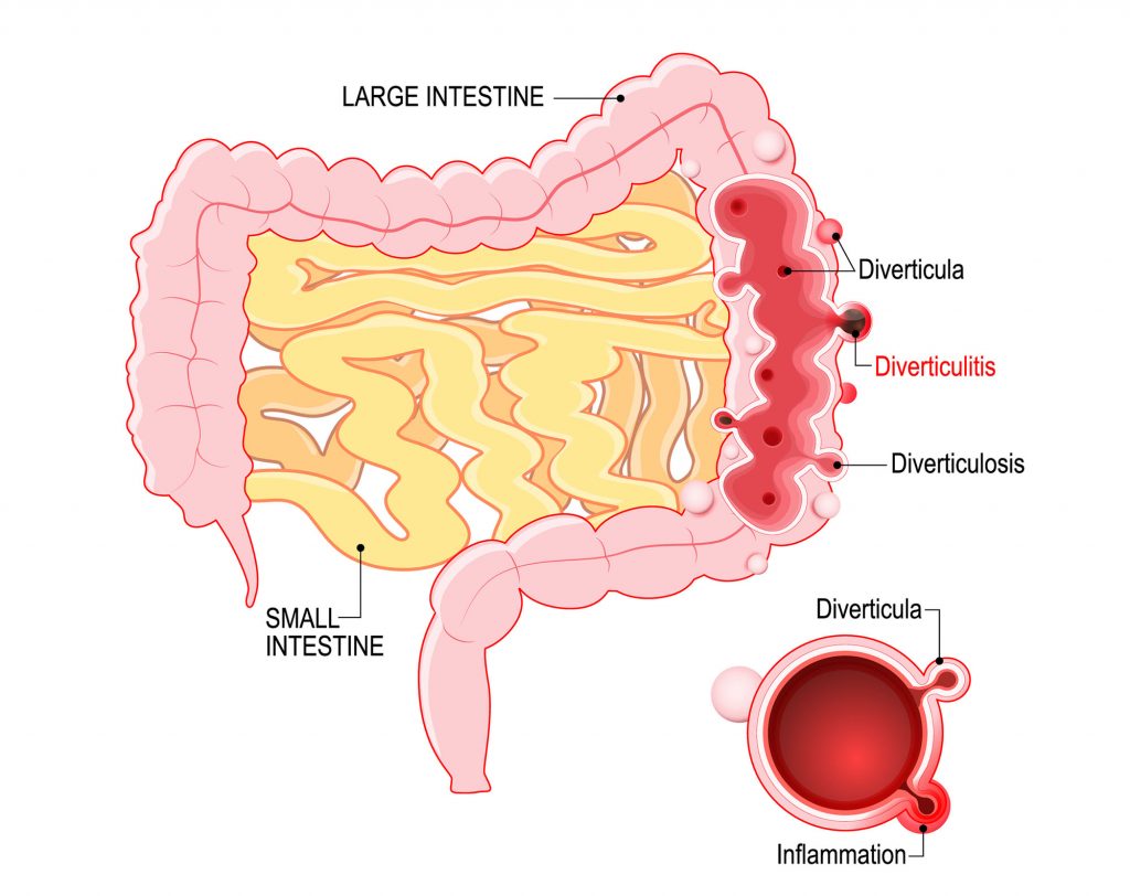 4b4 Lower GIT Disorders – HumanBio