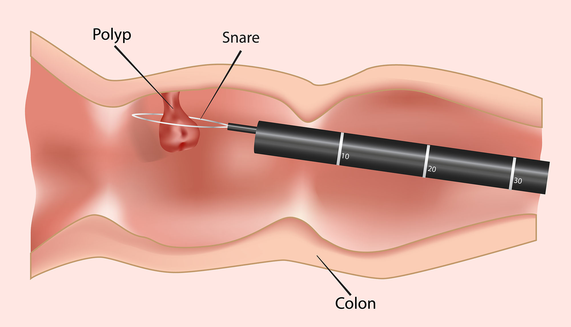 polyp removal